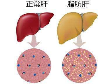 脂肪肝是如何形成的(这些问题要注意)-易百科